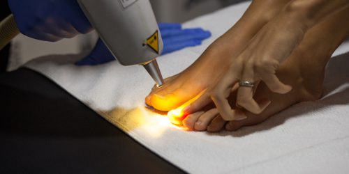 Uklanjanje gljivica na noktima laserom Uklanjanje gljivica na noktima laserom